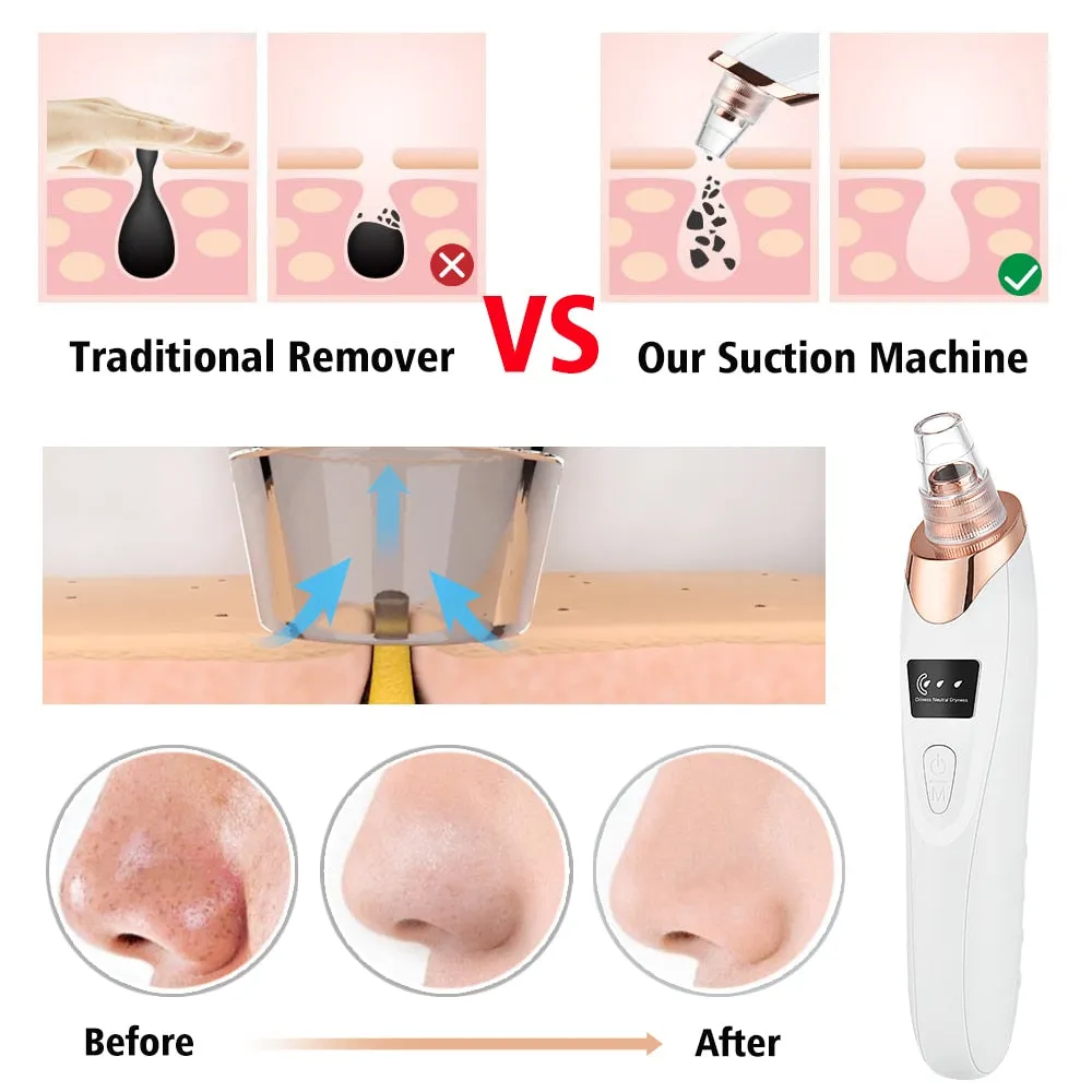 Vacuum Blackhead Remover